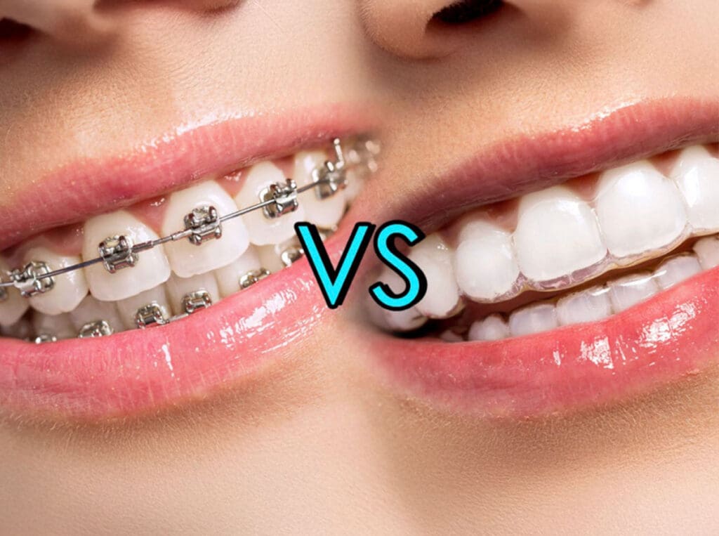 Braces vs. Invisalign