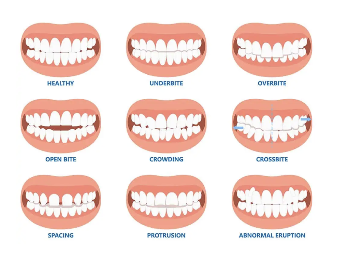 Different Teeth Conditions