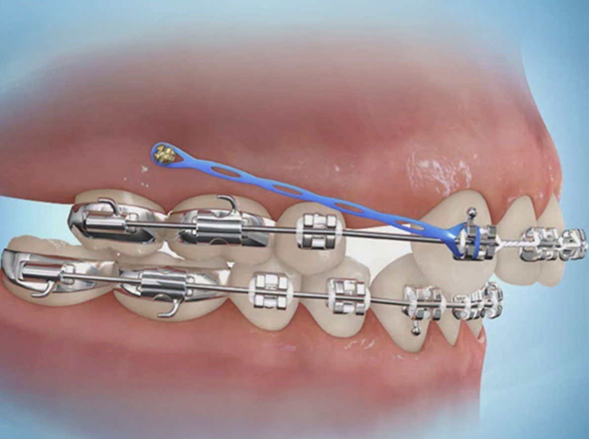 Traditional Braces and Clear Aligners